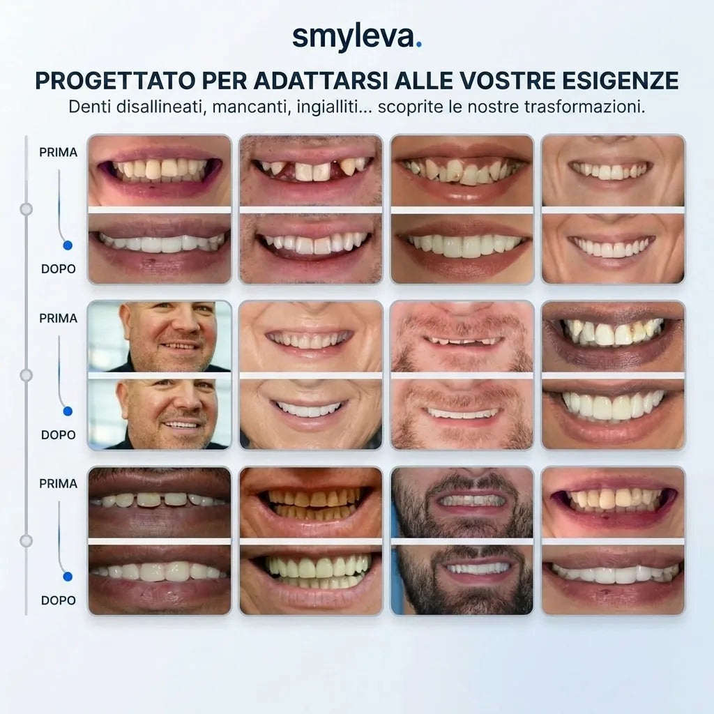 Faccette Adattabili e Rimovibili